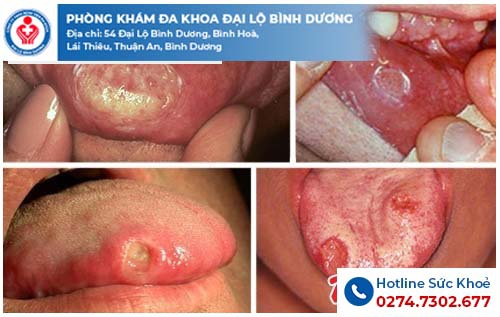Hình ảnh bệnh giang mai ở miệng cần lưu ý