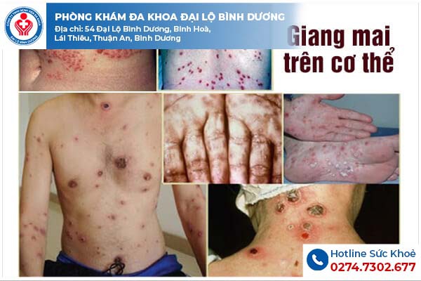 Hình ảnh giang mai trên cơ thể thường gặp