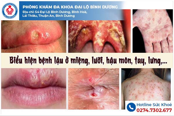 Hình ảnh của bệnh lậu ở những vị trí khác trên cơ thể