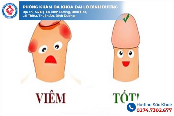 Viêm da cậu nhỏ ở nam giới